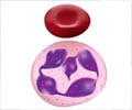 Megaloblastic Anemia - Causes, Symptoms, Signs, Diagnosis, Treatment, Prevention