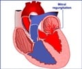 Mitral Regurgitation
