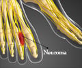 Morton's Neuroma - Causes, Symptoms, Diagnosis, Treatment, Prevention Morton's Neuroma - Causes, Symptoms, Diagnosis, Treatment, Prevention