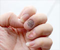 Nail Psoriasis - Causes, Symptoms, Diagnosis, Treatment & Prevention