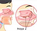 Nasal Polyp - Causes, Symptoms, Diagnosis, Treatment, Health Tips