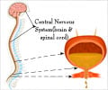 Neurogenic Bladder - Causes, Symptoms, Diagnosis, Treatment Neurogenic Bladder - Causes, Symptoms, Diagnosis, Treatment