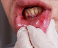 Oral Cancer | Mouth Cancer - Types, Causes, Symptoms, Diagnosis, Treatment & Prevention