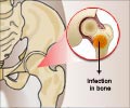 Osteomyelitis Osteomyelitis