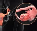 Ovarian Cancer | Cancer in the Ovaries - Causes, Symptoms, Treatment & Prevention