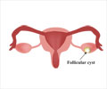 Ovarian Cysts - Types, Causes, Symptoms, Diagnosis, Treatment