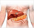 Pancreatitis