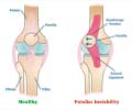 Patellar Instability | Kneecap Dislocation | Dislocation of Patella Patellar Instability | Kneecap Dislocation | Dislocation of Patella