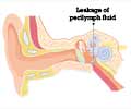 Perilymph Fistula                                                                                                                                                                                       