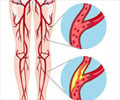Peripheral Artery Disease (PAD) - Causes, Symptoms, Diagnosis, Treatment & Prevention