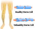 Peripheral Neuropathy - Types, Causes, Symptoms, Diagnosis, Treatment & Prevention Peripheral Neuropathy - Types, Causes, Symptoms, Diagnosis, Treatment & Prevention