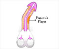 Peyronie´s Disease - Symptoms, Causes, Risk Factors, Complications, Diagnosis, Treatment