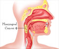 Throat Cancer / Pharyngeal Cancer - Types, Causes, Symptoms, Diagnosis and Treatment Throat Cancer / Pharyngeal Cancer - Types, Causes, Symptoms, Diagnosis and Treatment