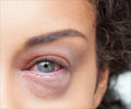 Pink Eye Symptom Evaluation                                                                                                                                                                             
