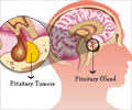 Pituitary Tumors - Causes, Symptoms, Diagnosis, Treatment Pituitary Tumors - Causes, Symptoms, Diagnosis, Treatment