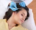 Plasma Treatment for Hair Loss
