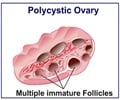 Polycystic Ovarian Syndrome - Overview