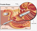 Prostate Biopsy-Preparations-Risks-Complications-Procedure-FAQ