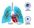 Pulmonary Arterial Hypertension [PAH] - Symptoms & Signs - Causes - Diagnosis - Treatment