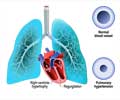 Pulmonary Hypertension Pulmonary Hypertension