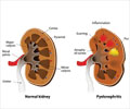Pyelonephritis - Causes, Symptoms, Diagnosis, Treatment & Prevention Pyelonephritis - Causes, Symptoms, Diagnosis, Treatment & Prevention