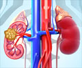 Radiofrequency Ablation (RFA) of Kidney Tumors Radiofrequency Ablation (RFA) of Kidney Tumors