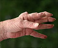 Rheumatoid Arthritis - Causes, Symptoms, Diagnosis, Treatment, FAQs