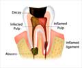 Root Canal Treatment                                                                                                                                                                                    