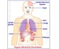 Sarcoidosis - Symptoms - Diagnosis - Treatment - Prognosis