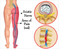 Sciatica - Causes, Symptoms, Diagnosis, Treatment, Prevention, Health Tips