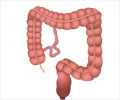 Short Bowel Syndrome - Causes, Symptoms, Complications, Diagnosis & Treatment