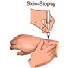 Skin Biopsy-Procedure-Punch-Shave-Incisional-FAQ-Video