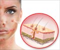 Skin Pigmentation Disorders: Hyperpigmentation & Hypopigmentation Skin Pigmentation Disorders: Hyperpigmentation & Hypopigmentation