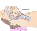 Obstructive Sleep Apnea