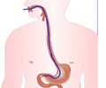 Small Intestine Biopsy