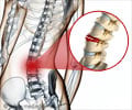 Spinal Fracture - Causes, Symptoms, Diagnosis, Treatment Spinal Fracture - Causes, Symptoms, Diagnosis, Treatment