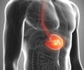 Stomach Cancer | Gastric Cancer