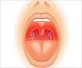 Strep Throat - Symptom Evaluation