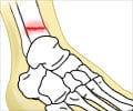 Stress Fracture - Causes, Symptoms, Diagnosis, Treatment Stress Fracture - Causes, Symptoms, Diagnosis, Treatment