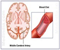 Stroke – Early Warning Signs - Risk Factor - Rehab - Treatment
