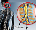 Syringomyelia | Hydromyelia | Syrinx: Causes Symptoms Diagnosis Treatment Syringomyelia | Hydromyelia | Syrinx: Causes Symptoms Diagnosis Treatment