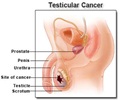 Testicular Cancer - Risk Factors - Symptoms - Diagnosis - Staging - Treatment - Prognosis