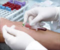 Tests for Hepatitis                                                                                                                                                                                     