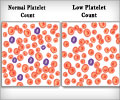 Thrombocytopenia / Low Platelet Count - Causes Symptoms Diagnosis Treatment