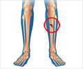 Tibia (Shinbone) Shaft Fractures - Causes, Symptoms, Diagnosis, Treatment Tibia (Shinbone) Shaft Fractures - Causes, Symptoms, Diagnosis, Treatment