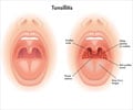 Tonsillitis - Types, Causes, Symptoms, Complications, Diagnosis & Treatment