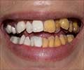Tooth Discoloration Introduction