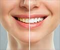 Tooth Whitening—Guide to a Brighter Smile