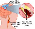 Transient Ischemic Attack Transient Ischemic Attack