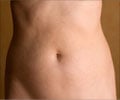 Tummy Tuck or Abdominoplasty - Indication - Procedure - Recovery - Risk - FAQs Tummy Tuck or Abdominoplasty - Indication - Procedure - Recovery - Risk - FAQs